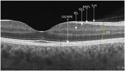 Differentiation of the retinal morphology aging trajectories in schizophrenia and their associations with cognitive dysfunctions